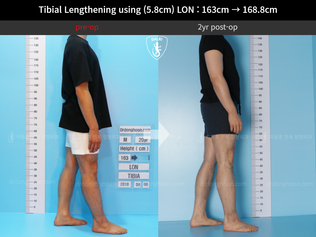 Before and after cll lon, case 11468172, image 3, Dr. Donghoon institute (DALRI)