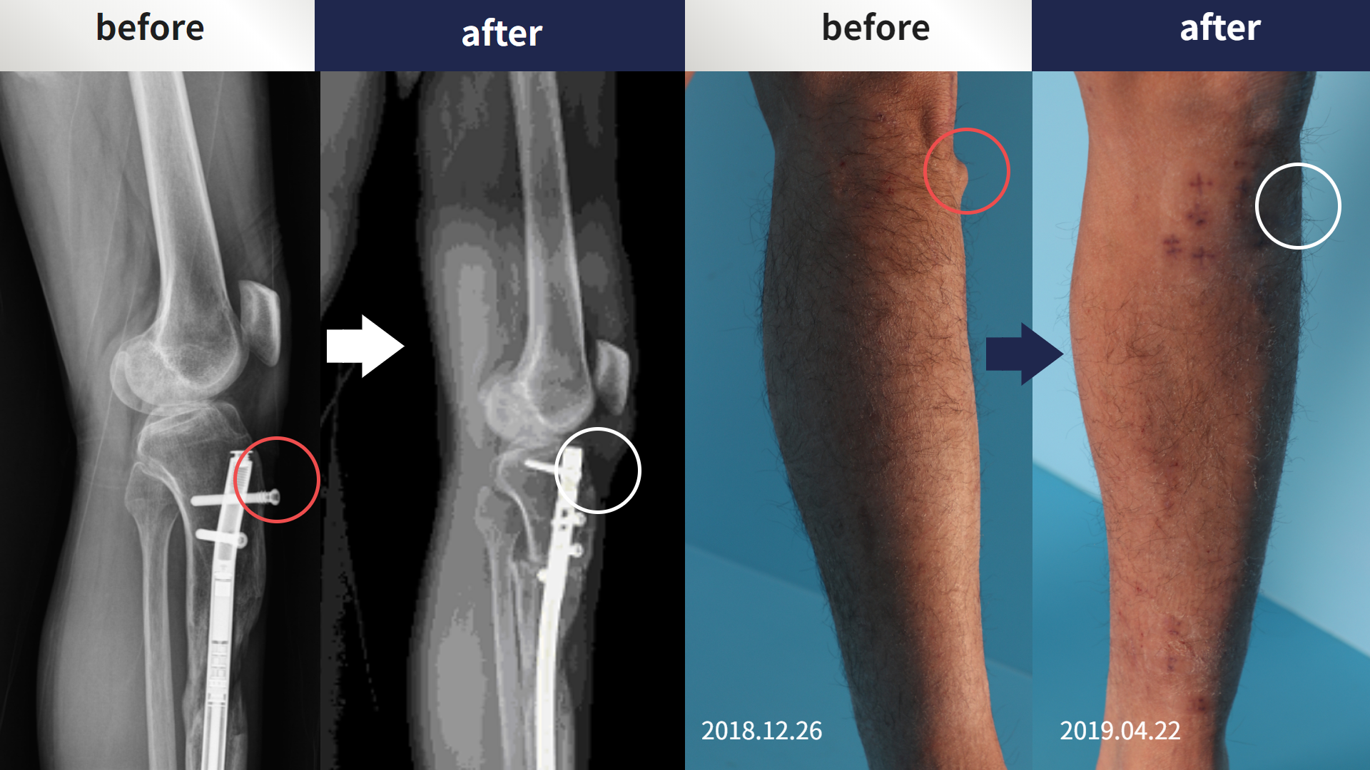 Before and after re-operation for cll, case 4465600, image 4, Dr. Donghoon institute (DALRI)