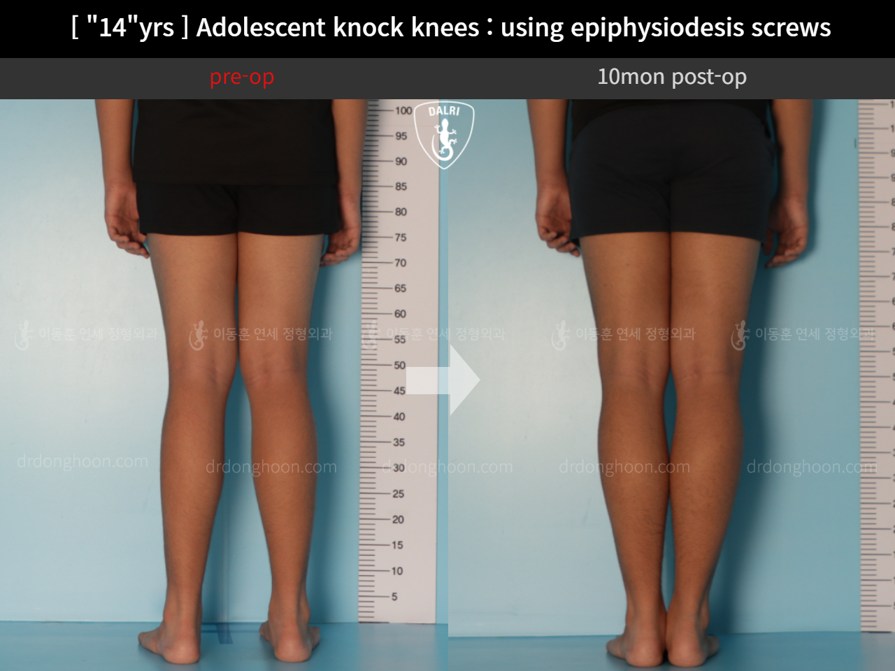 Before and after paediatric & adolescent knock knees, case 11674972, image 4, Dr. Donghoon institute (DALRI)