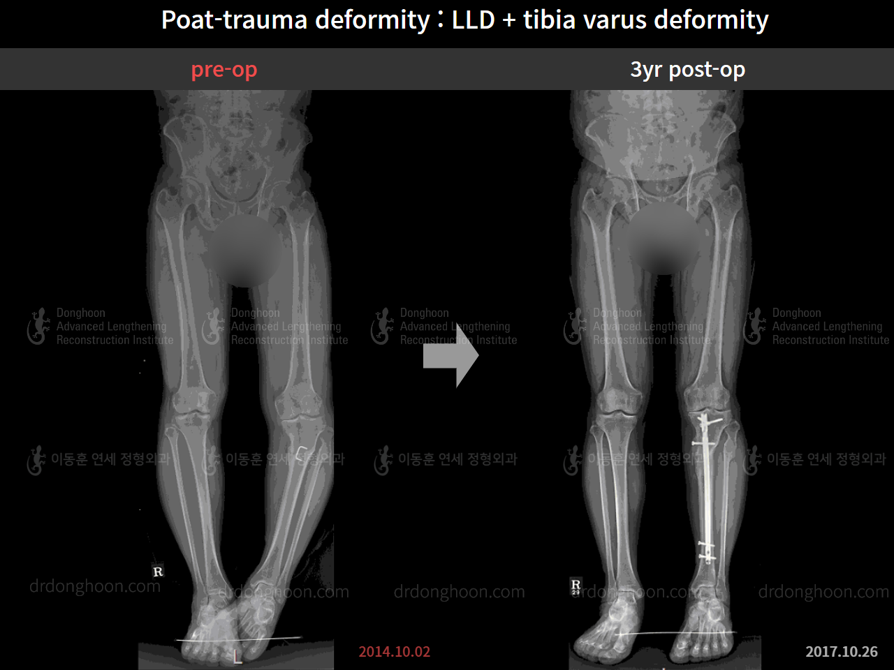 Before and after post-trauma deformity, case 4251798, image 3, Dr. Donghoon institute (DALRI)