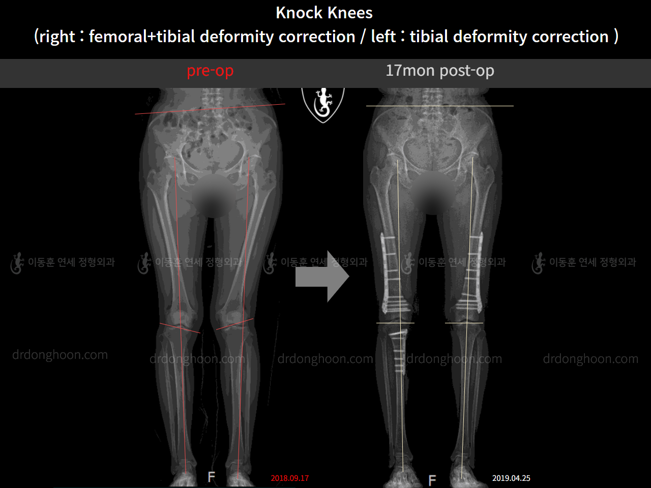 Before and after adult knock knees, case 4640565, image 7, Dr. Donghoon institute (DALRI)