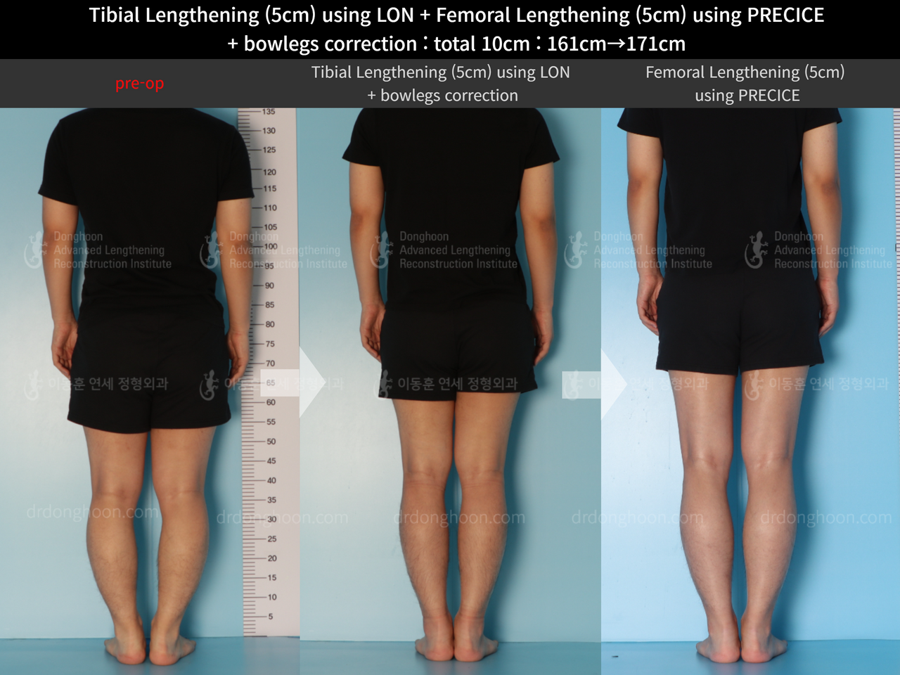 Before and after cll precice, case 13660867, image 2, Dr. Donghoon institute (DALRI)