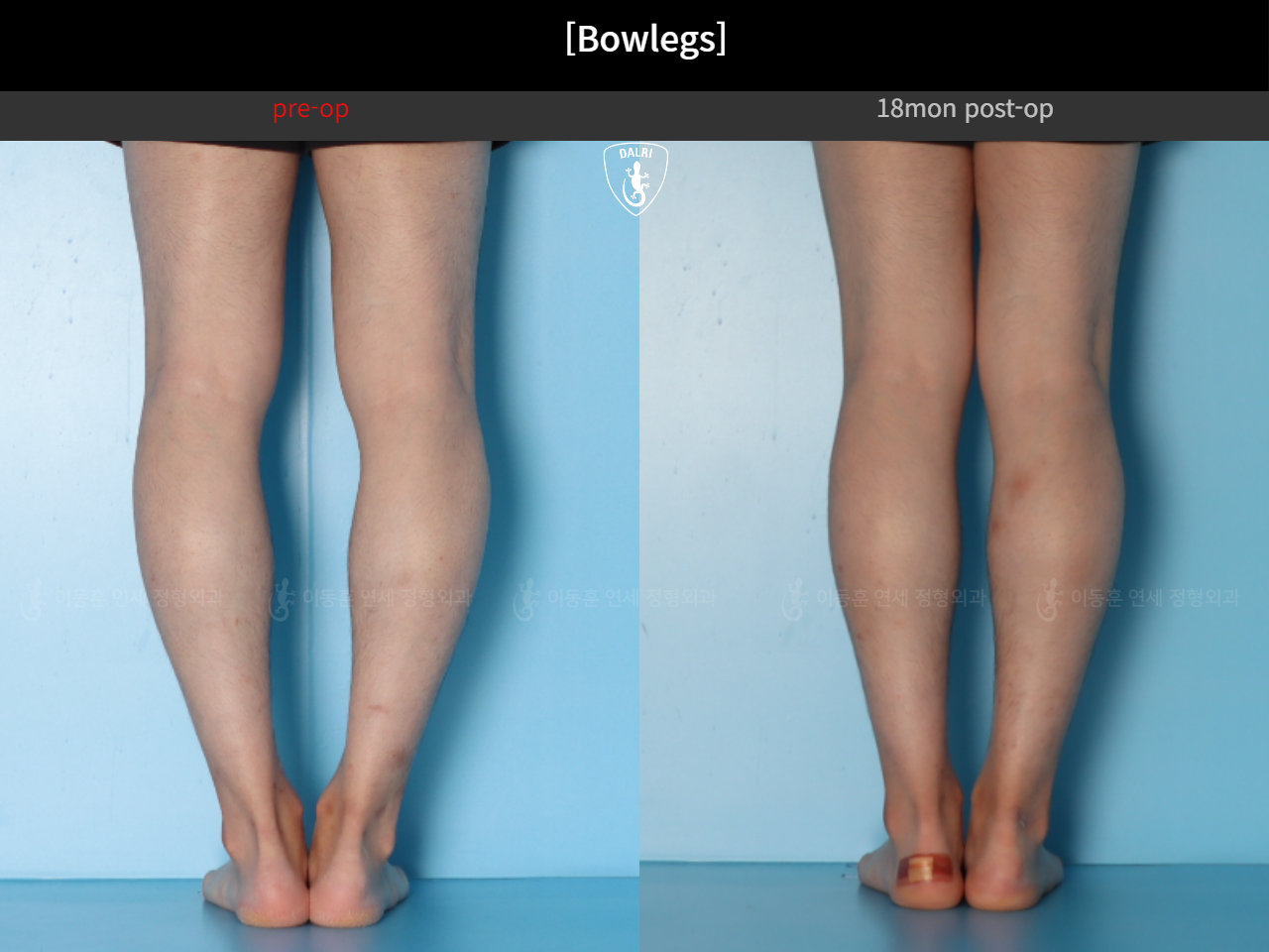 Before and after adult bowlegs, case 124254182, image 9, Dr. Donghoon institute (DALRI)
