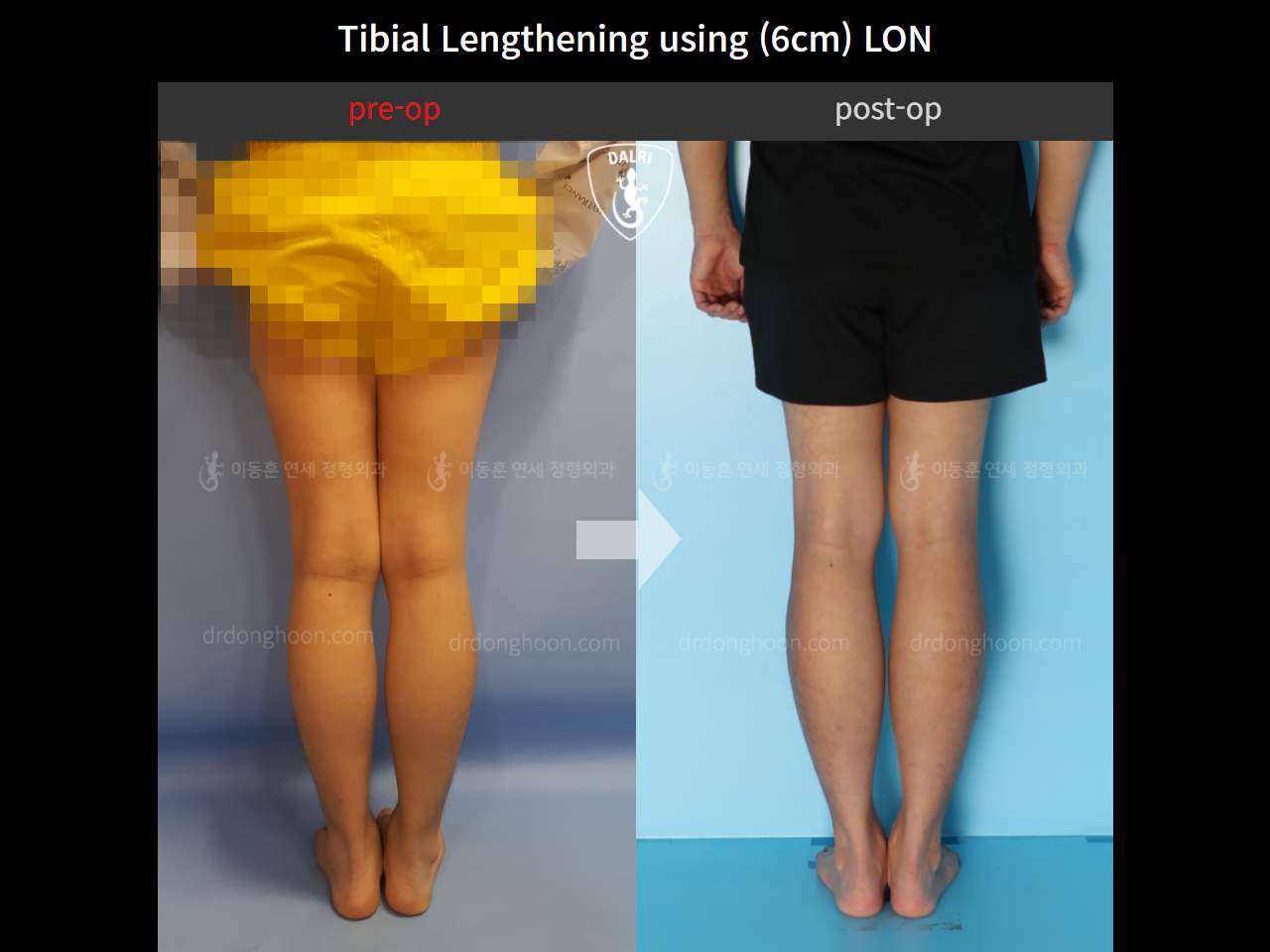 Before and after cll lon, case 11087271, image 6, Dr. Donghoon institute (DALRI)