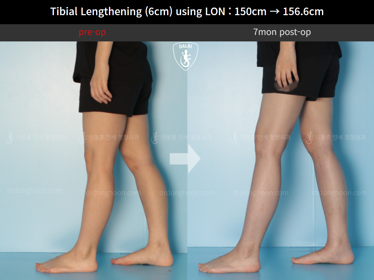 Before and after cll lon, case 9992030, image 7, Dr. Donghoon institute (DALRI)