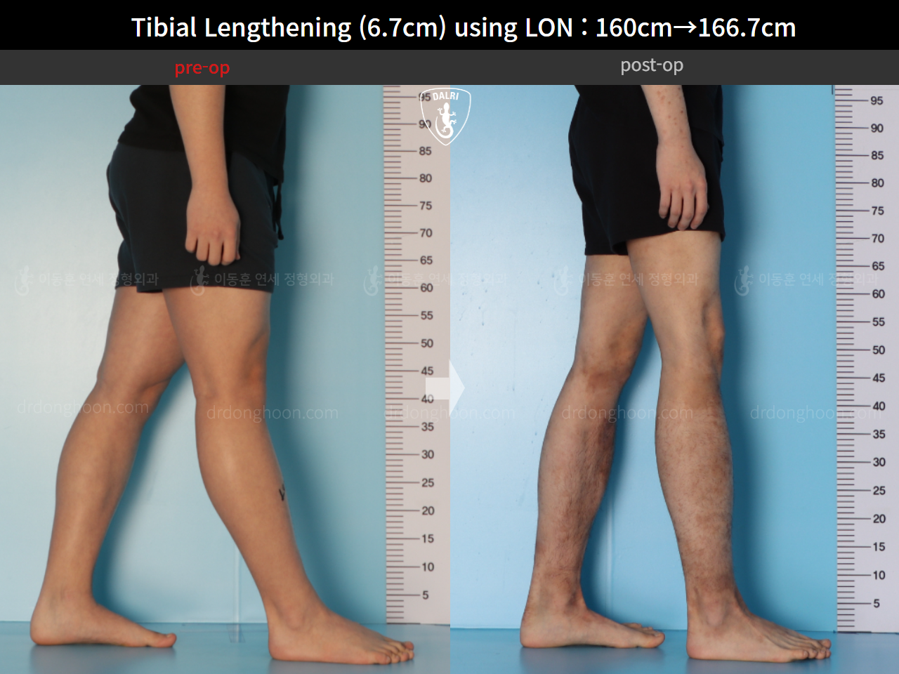 Before and after cll lon, case 15544530, image 8, Dr. Donghoon institute (DALRI)