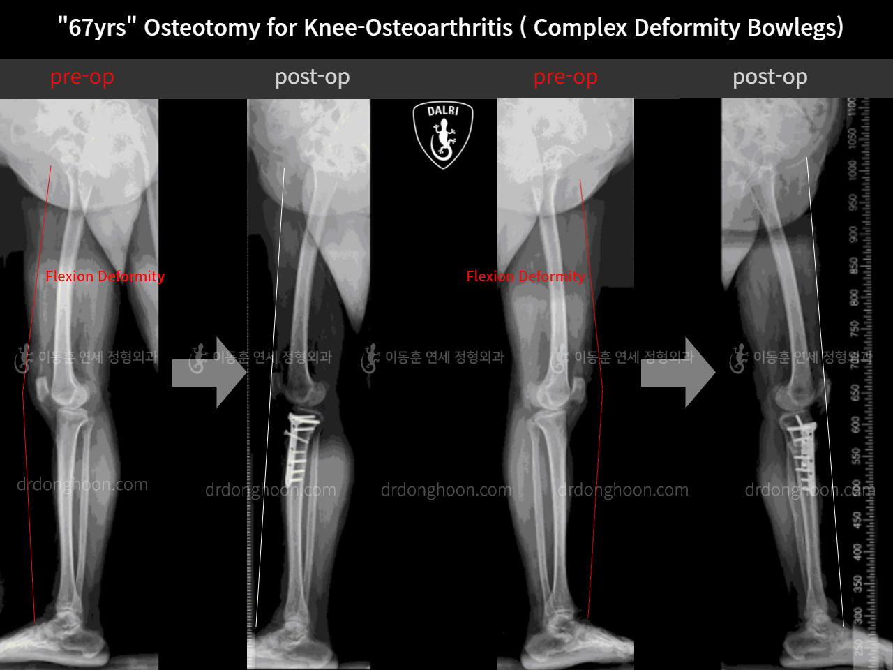 Before and after adult bowlegs, case 11339434, image 9, Dr. Donghoon institute (DALRI)