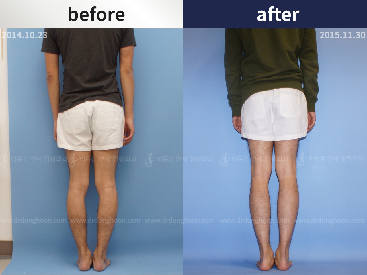 Before and after cll lon, case 4323918, image 3, Dr. Donghoon institute (DALRI)