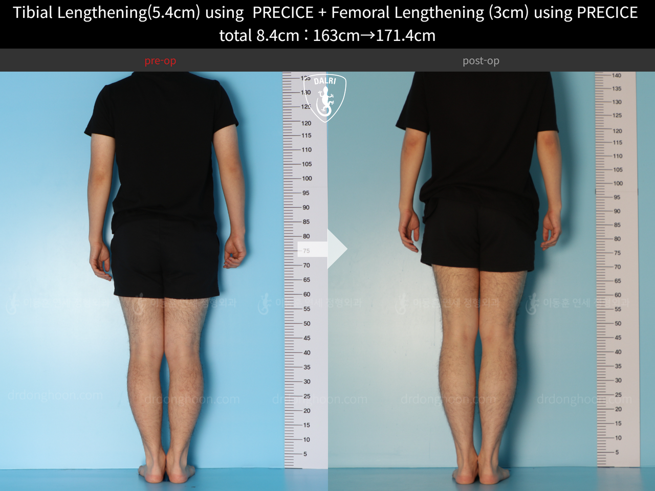 Before and after cll precice, case 12051302, image 4, Dr. Donghoon institute (DALRI)