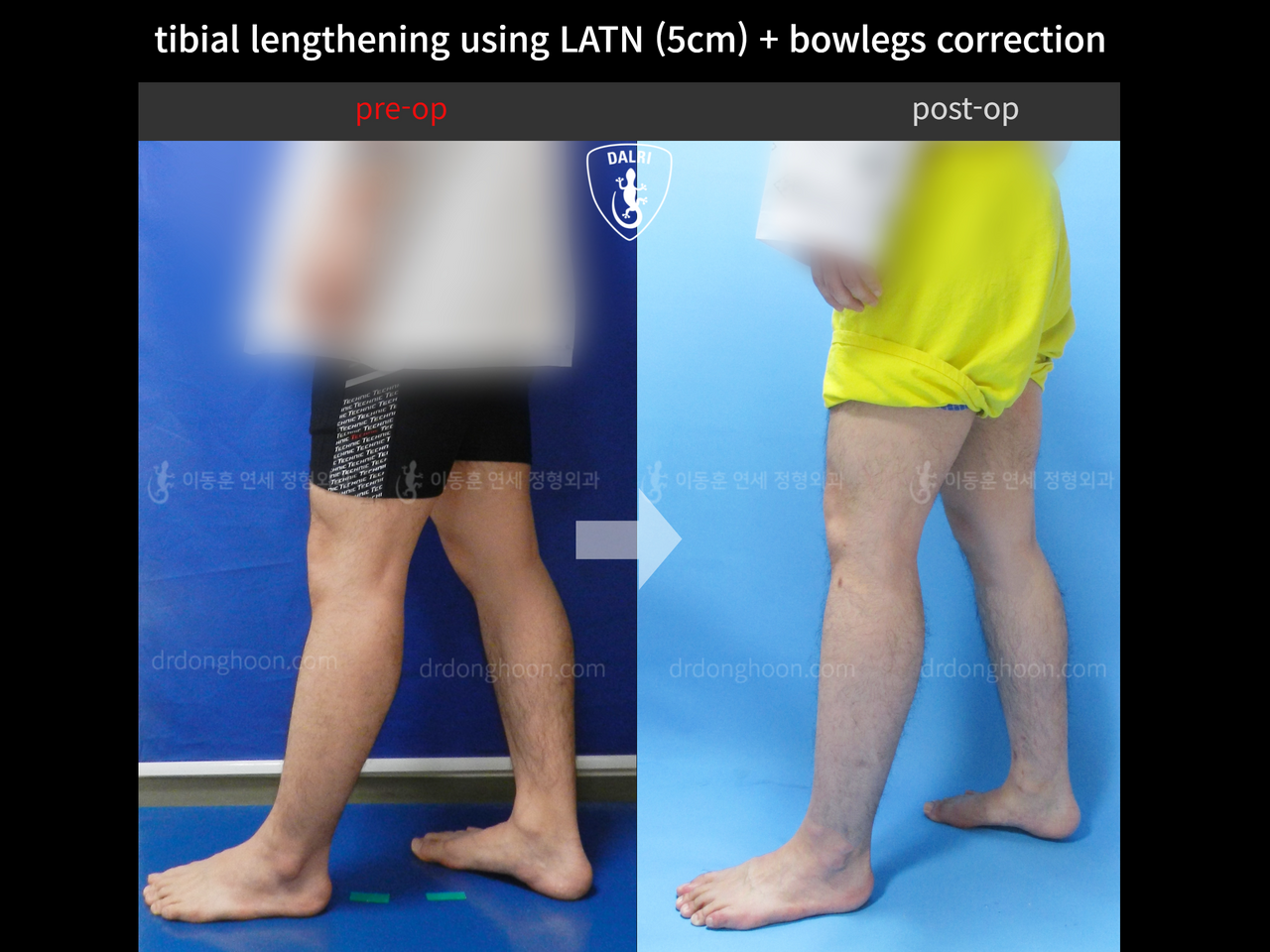 Before and after cll + deformity correction, case 4323109, image 3, Dr. Donghoon institute (DALRI)