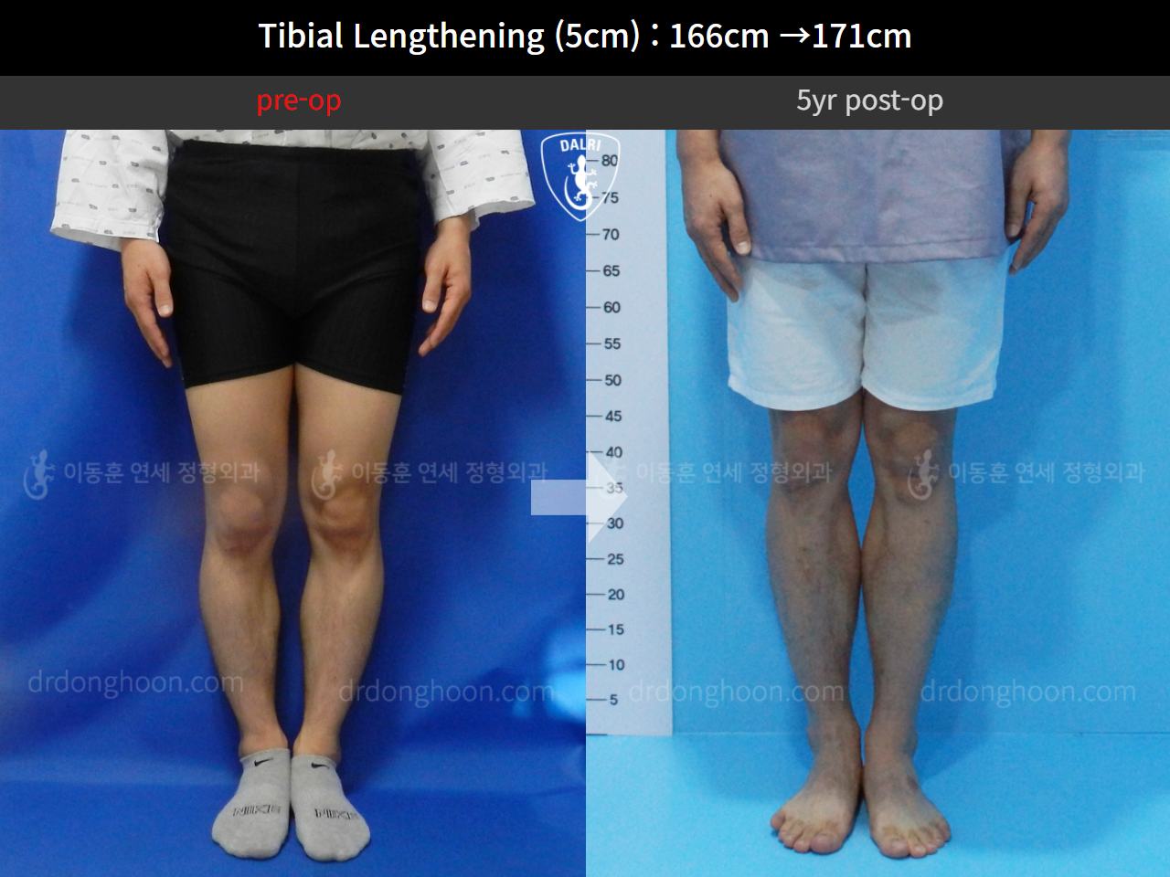Before and after cll precice, case 4323361, image 2, Dr. Donghoon institute (DALRI)