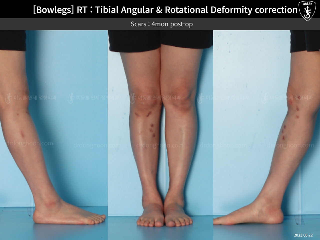 Before and after adult bowlegs, case 15741874, image 10, Dr. Donghoon institute (DALRI)