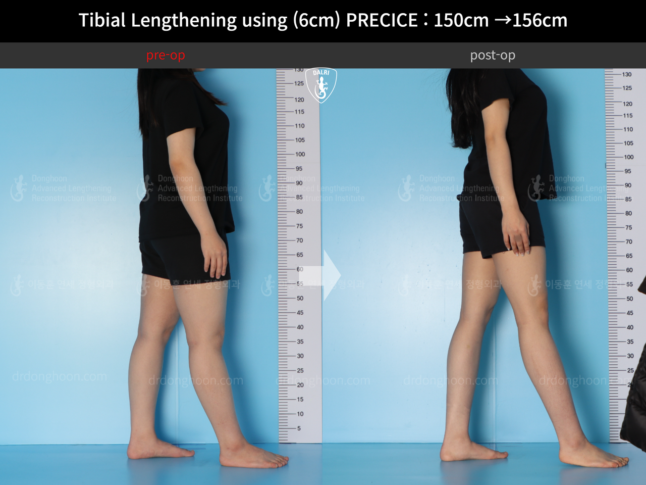 Before and after cll precice, case 14065180, image 3, Dr. Donghoon institute (DALRI)