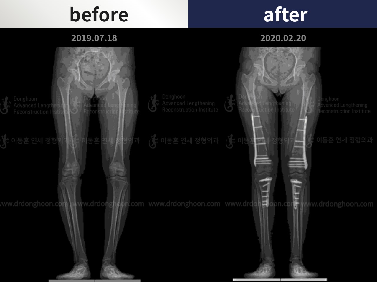 Before and after paediatric & adolescent bowlegs, case 4585796, image 3, Dr. Donghoon institute (DALRI)