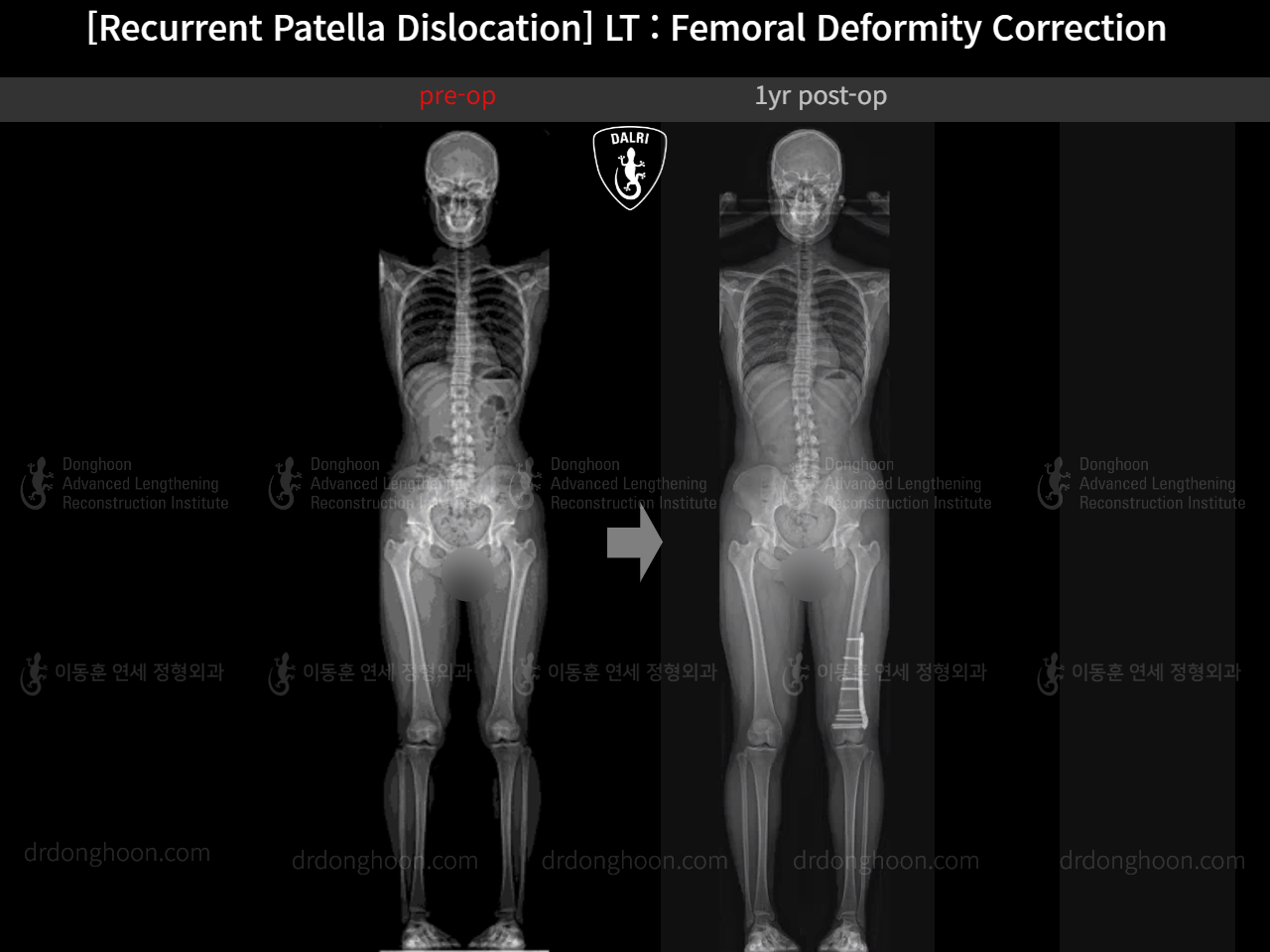 Before and after recurrent patella dislocation, case 15125370, image 6, Dr. Donghoon institute (DALRI)