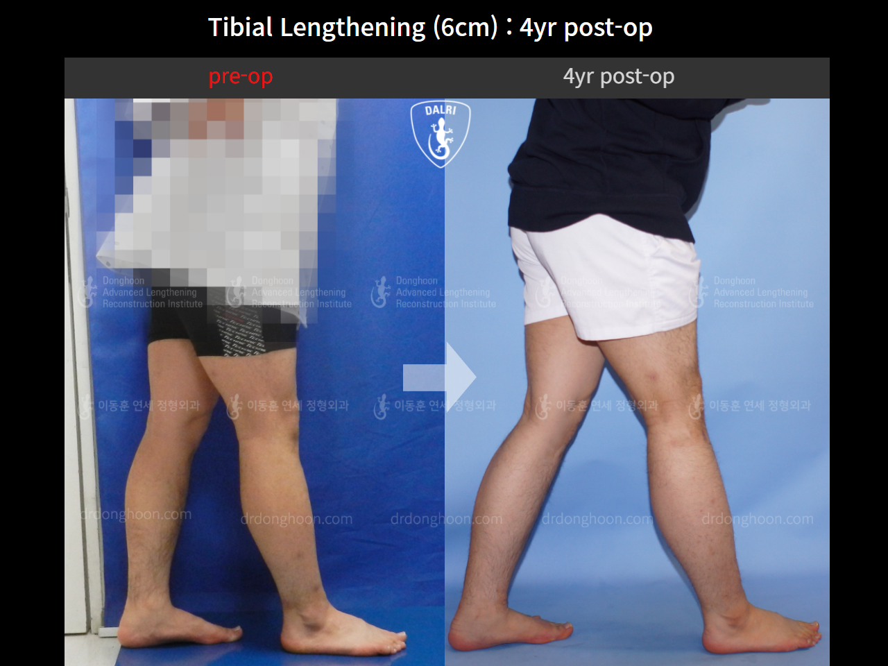 Before and after cll lon, case 10474212, image 6, Dr. Donghoon institute (DALRI)