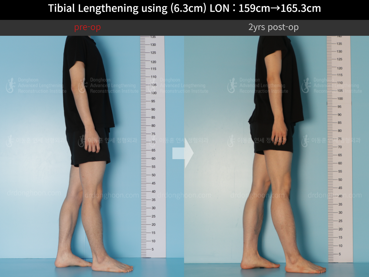 Before and after cll lon, case 12096536, image 5, Dr. Donghoon institute (DALRI)