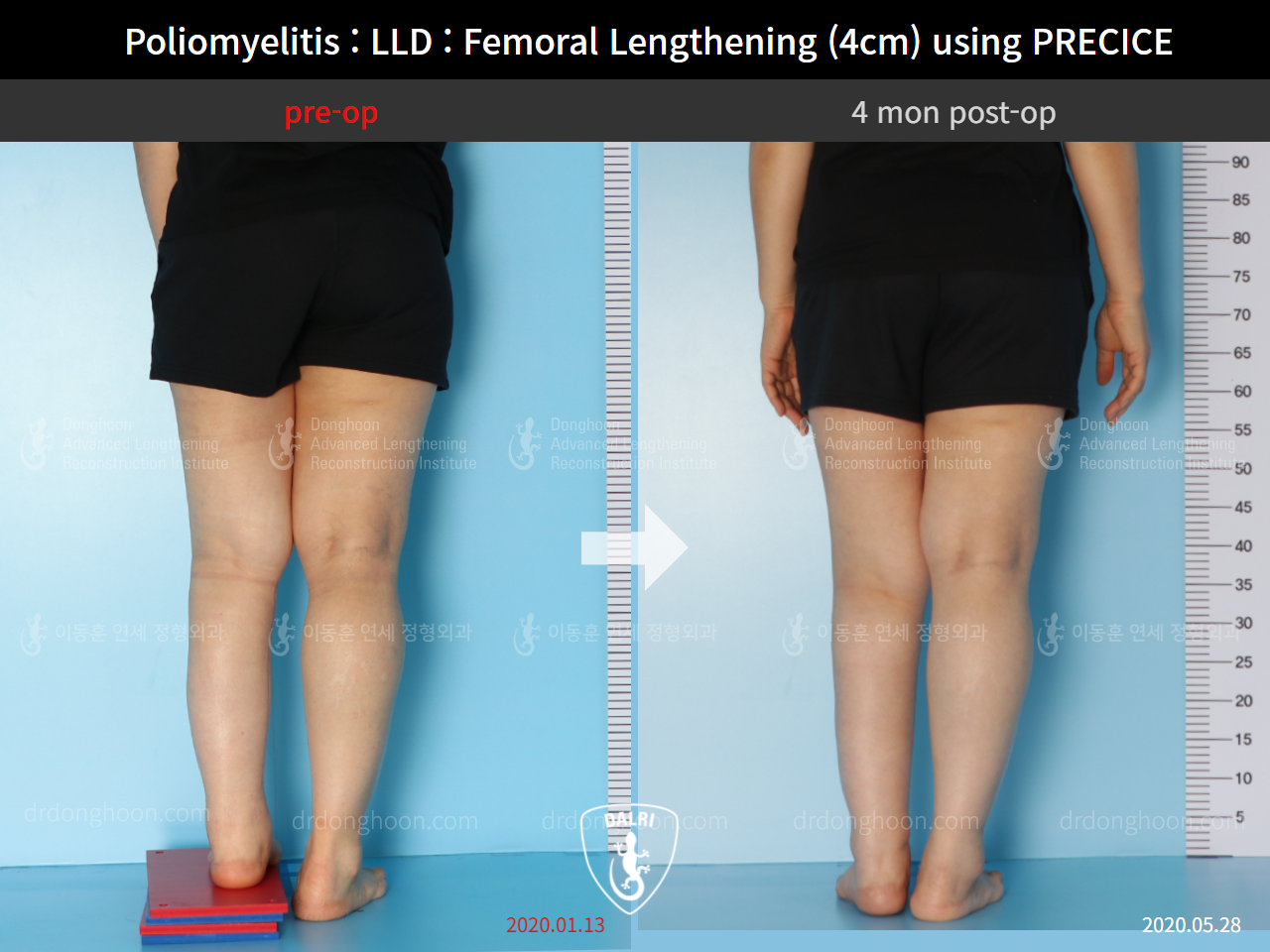 Before and after congenital condition, case 9191055, image 5, Dr. Donghoon institute (DALRI)