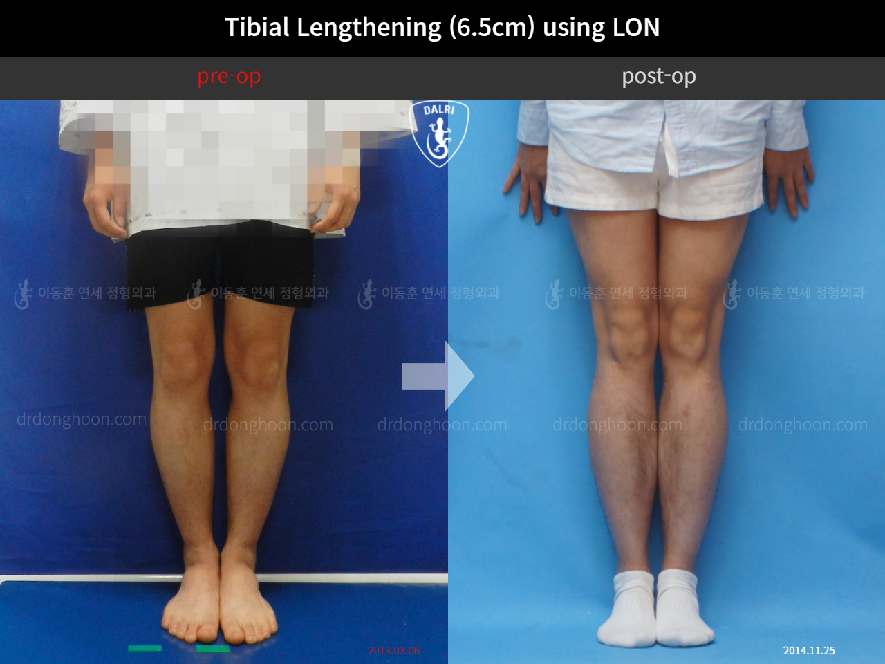 Before and after cll lon, case 4323965, image 3, Dr. Donghoon institute (DALRI)