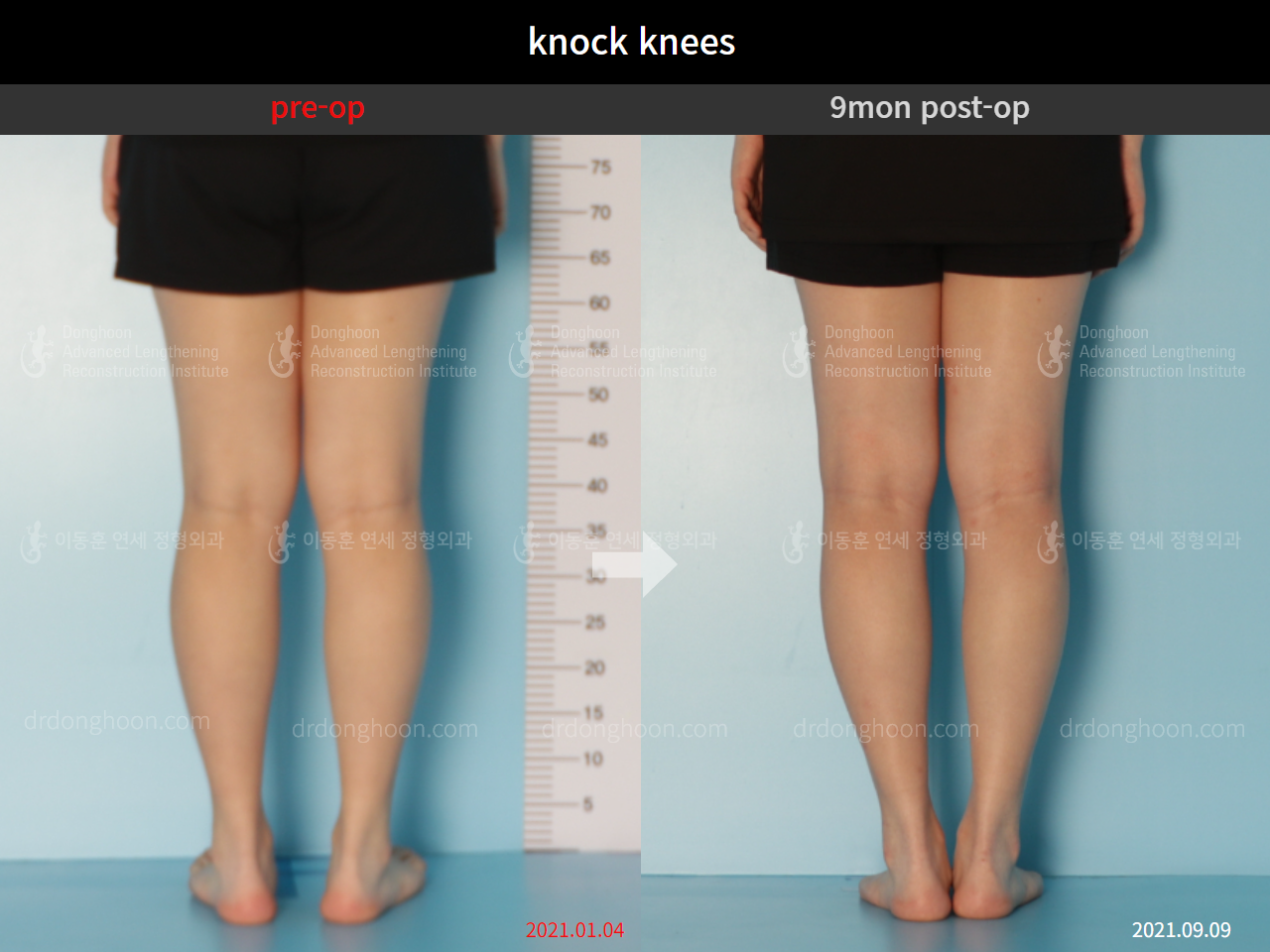 Before and after adult knock knees, case 9095996, image 4, Dr. Donghoon institute (DALRI)