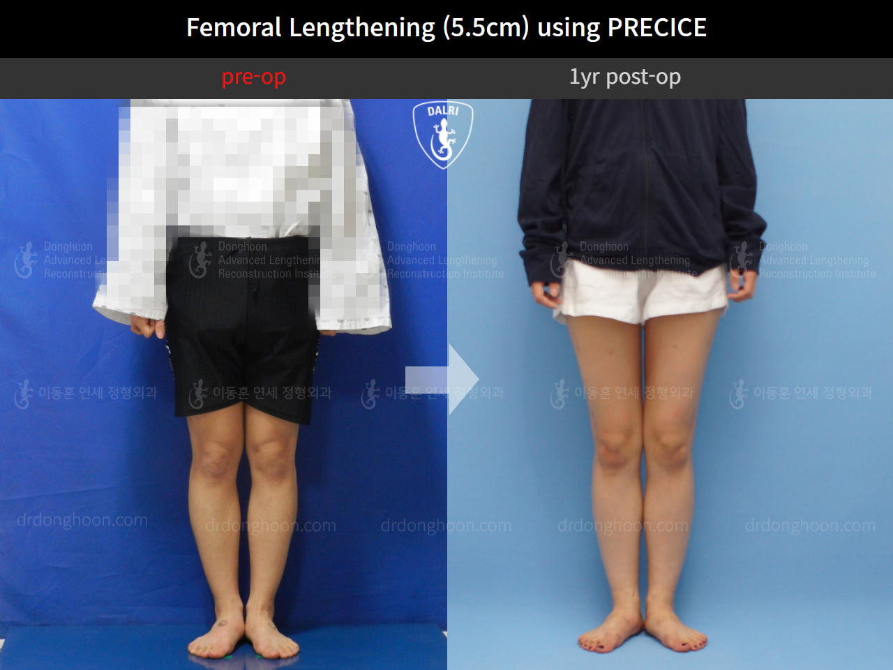Before and after cll precice, case 4573623, image 2, Dr. Donghoon institute (DALRI)