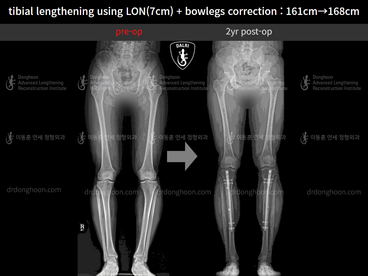 Before and after cll + deformity correction, case 10400088, image 9, Dr. Donghoon institute (DALRI)