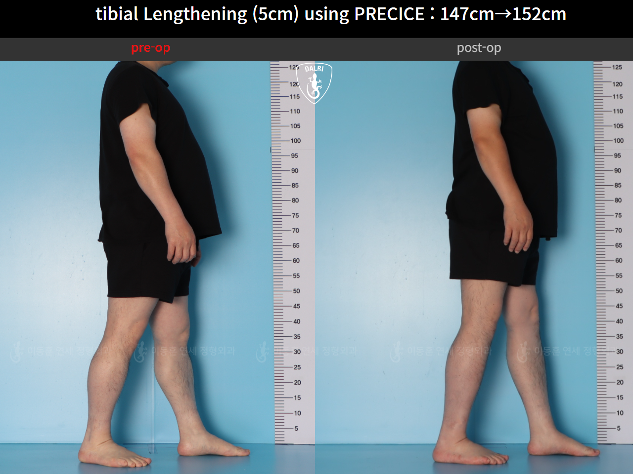 Before and after cll precice, case 89098588, image 6, Dr. Donghoon institute (DALRI)