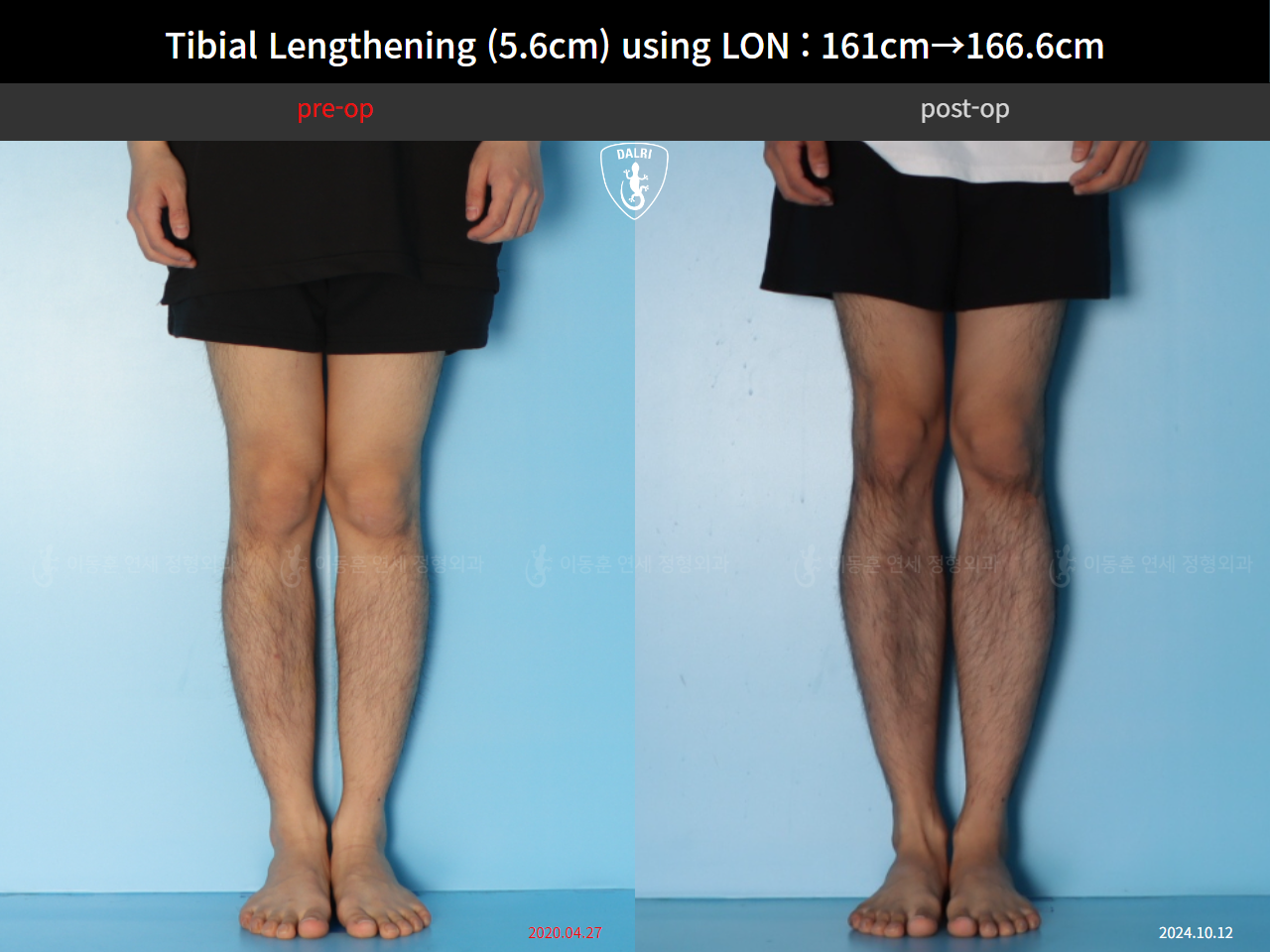 Before and after cll lon, case 126542150, image 5, Dr. Donghoon institute (DALRI)