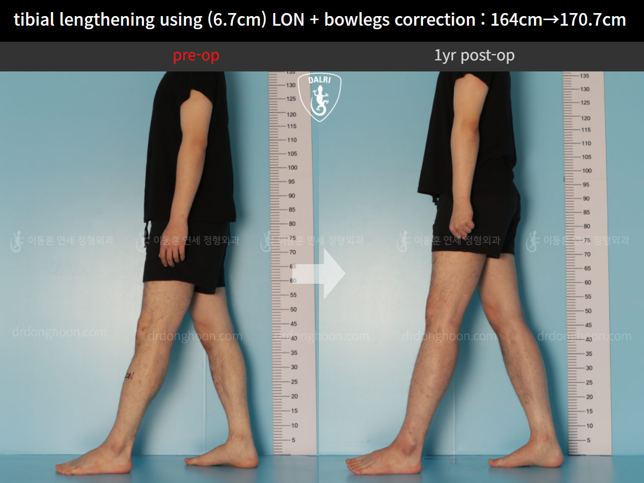 Before and after cll + deformity correction, case 11037343, image 4, Dr. Donghoon institute (DALRI)