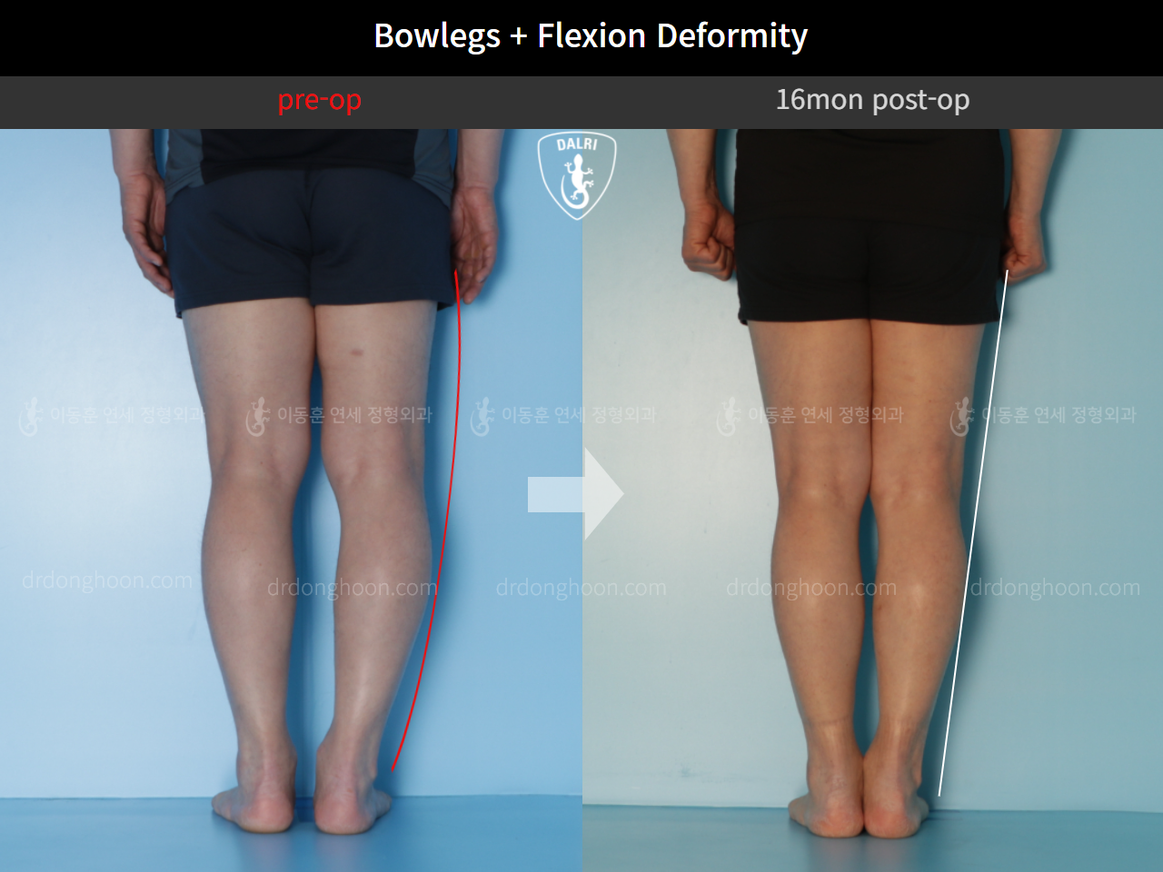 Before and after adult bowlegs, case 10451182, image 5, Dr. Donghoon institute (DALRI)