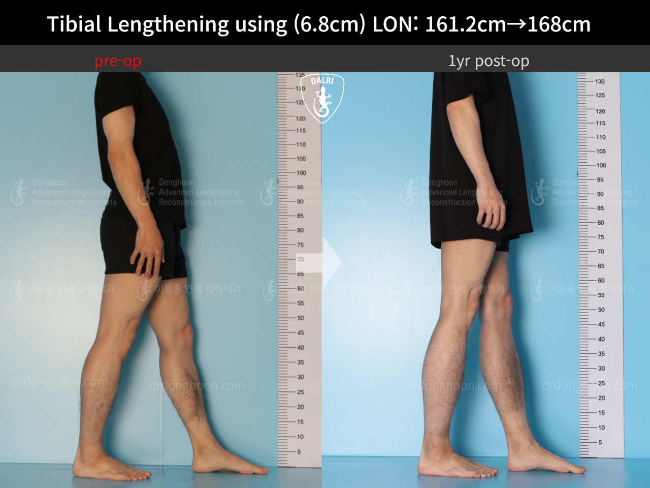 Before and after cll lon, case 13633878, image 6, Dr. Donghoon institute (DALRI)