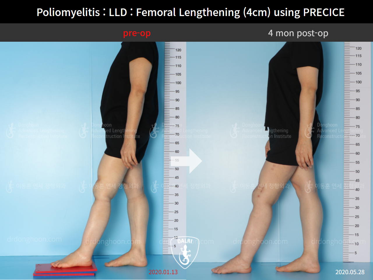 Before and after congenital condition, case 9191055, image 3, Dr. Donghoon institute (DALRI)