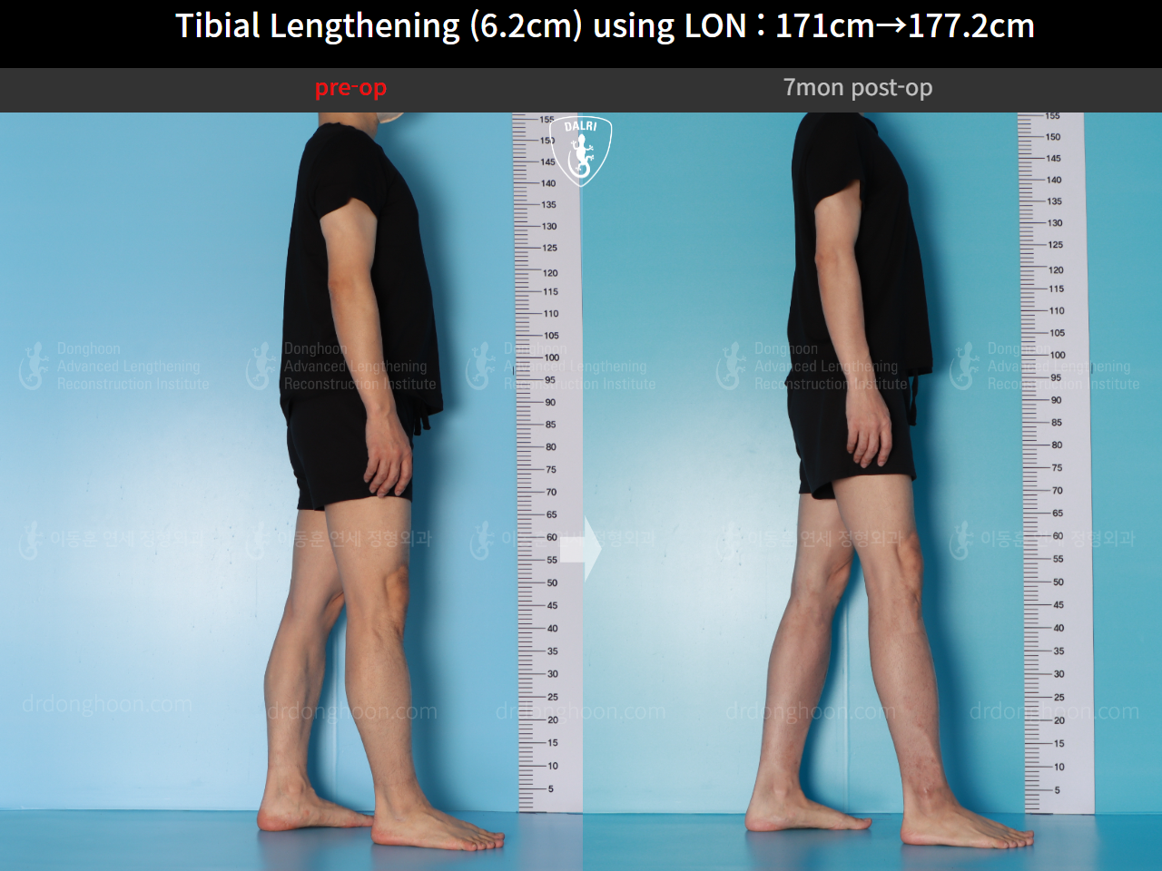 Before and after cll lon, case 16713373, image 5, Dr. Donghoon institute (DALRI)
