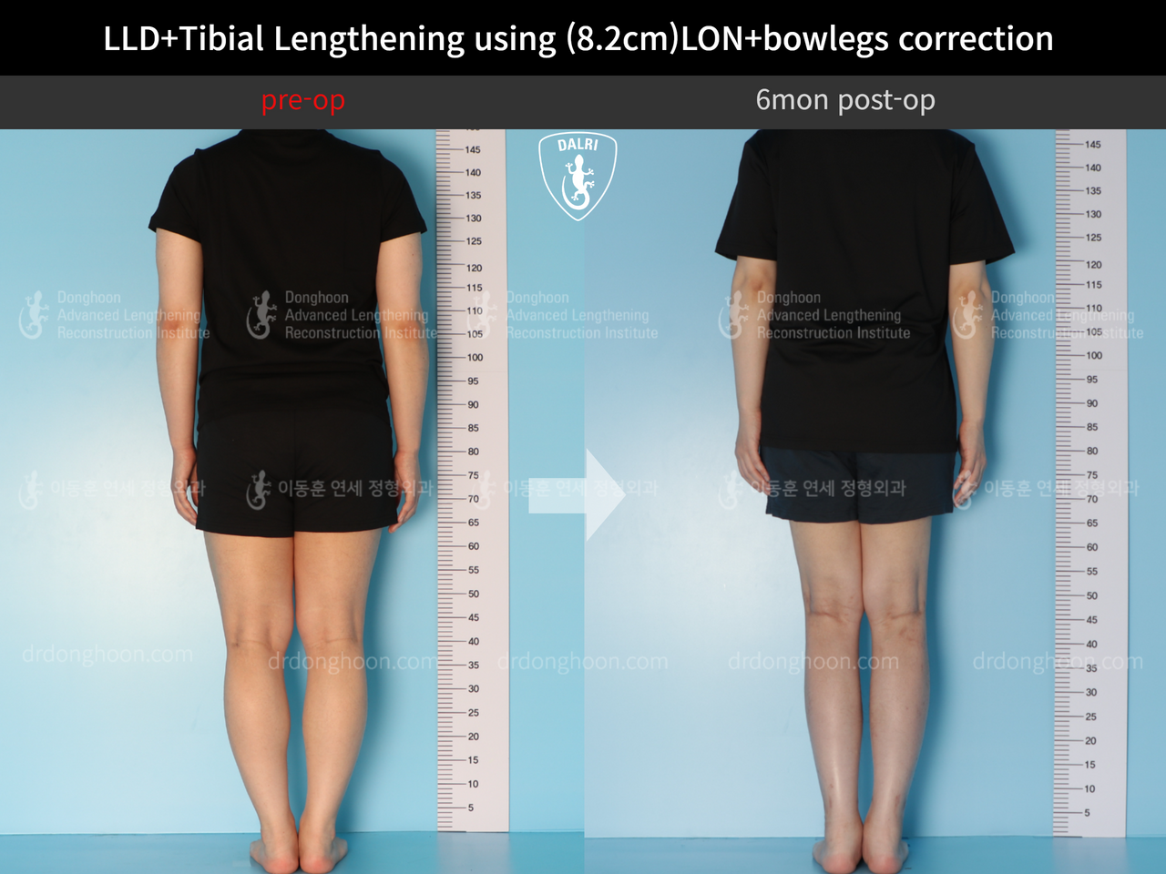 Before and after cll + deformity correction, case 12782230, image 2, Dr. Donghoon institute (DALRI)