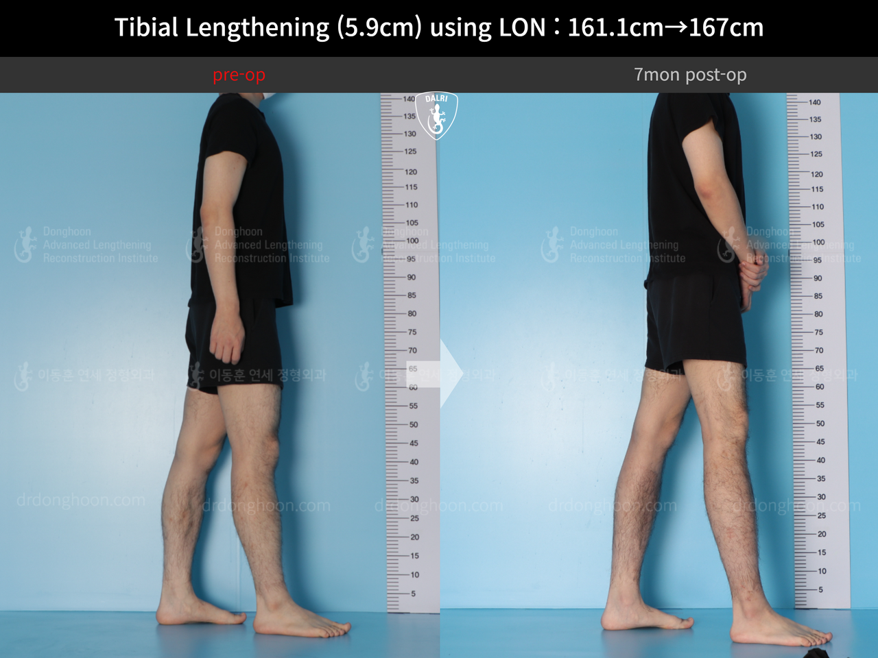 Before and after cll lon, case 14064750, image 3, Dr. Donghoon institute (DALRI)