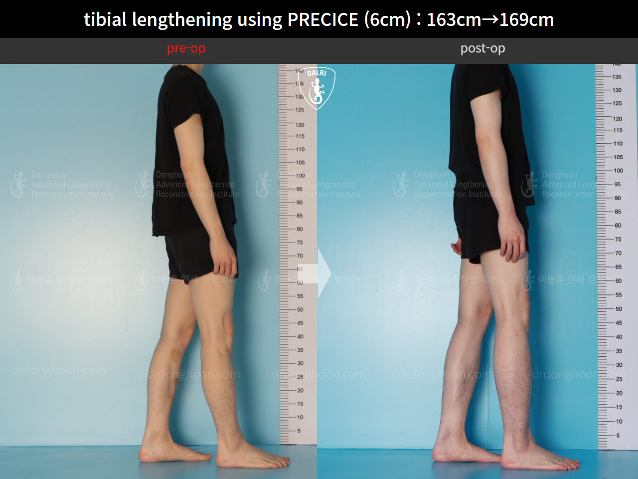 Before and after cll precice, case 16061529, image 6, Dr. Donghoon institute (DALRI)