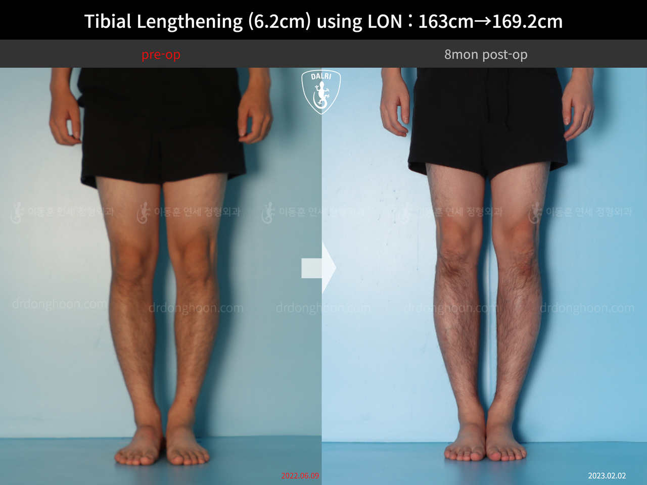 Before and after cll lon, case 14135787, image 7, Dr. Donghoon institute (DALRI)