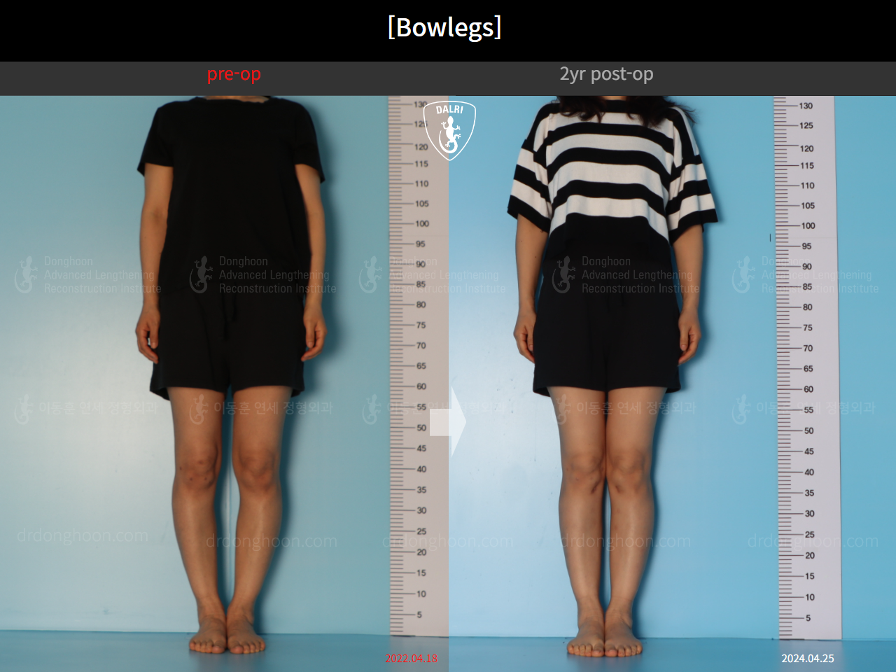 Before and after adult bowlegs, case 20942169, image 1, Dr. Donghoon institute (DALRI)