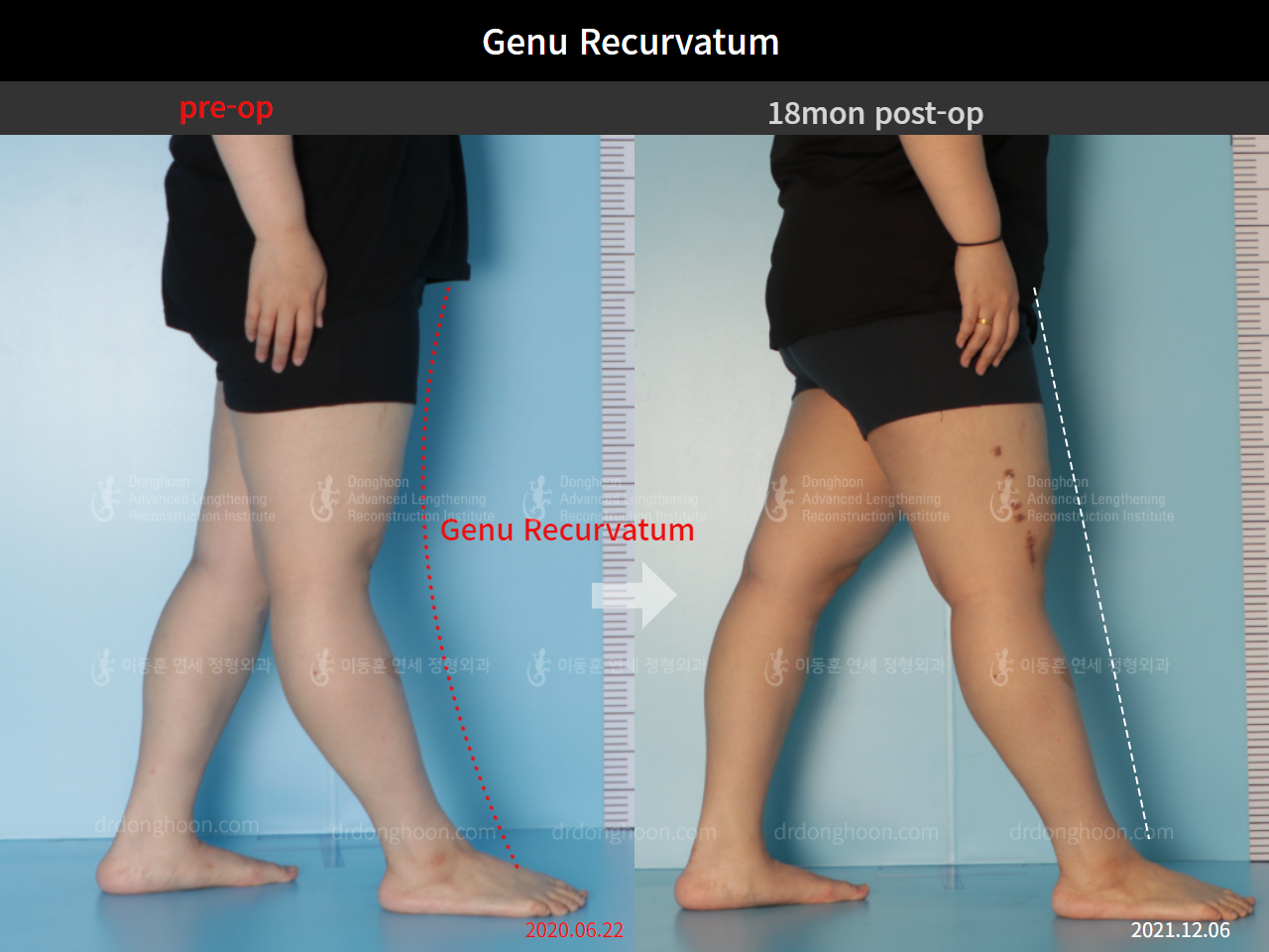 Before and after genu recurvatum, case 5656817, image 2, Dr. Donghoon institute (DALRI)
