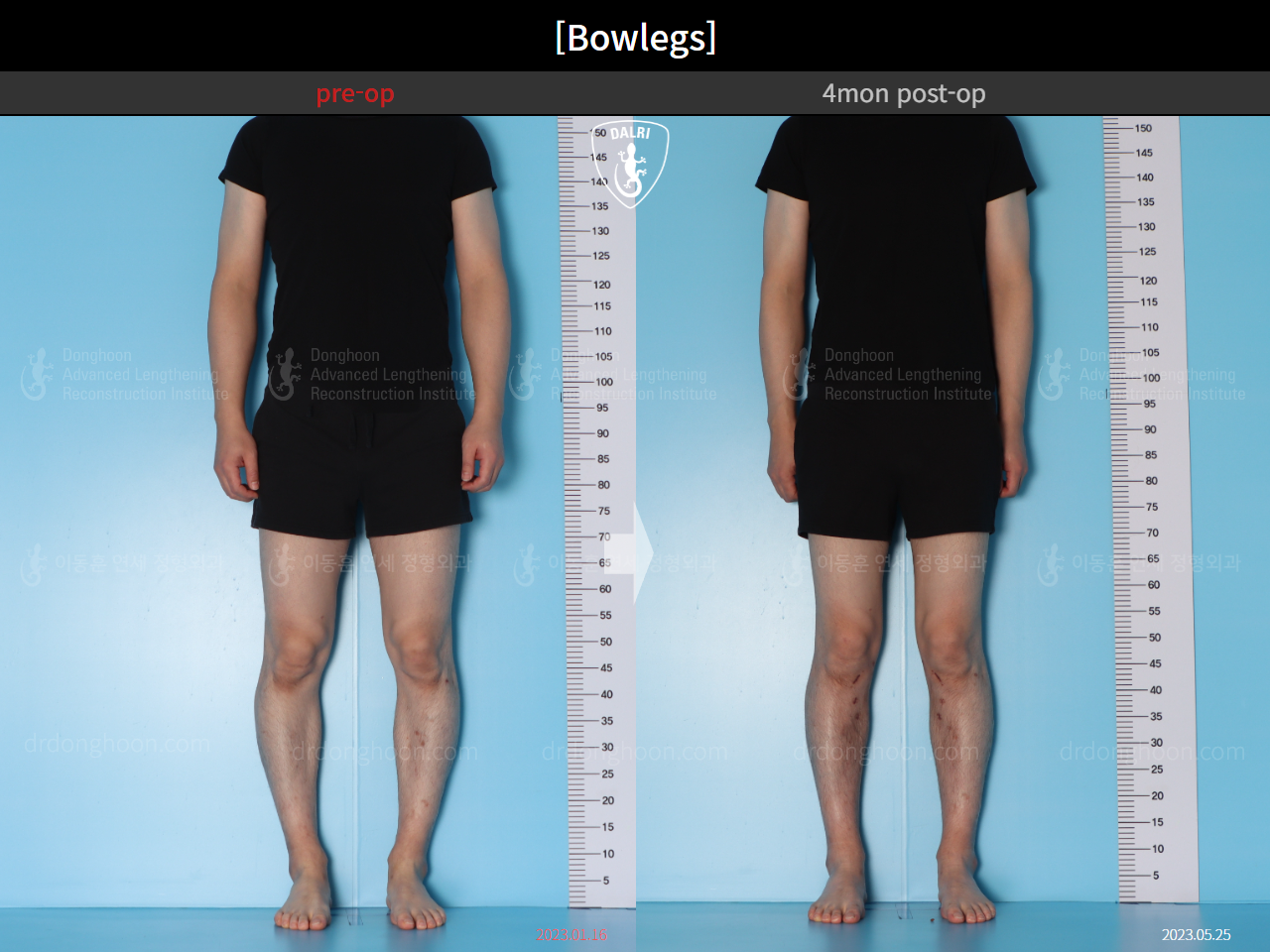 Before and after adult bowlegs, case 15650289, image 3, Dr. Donghoon institute (DALRI)
