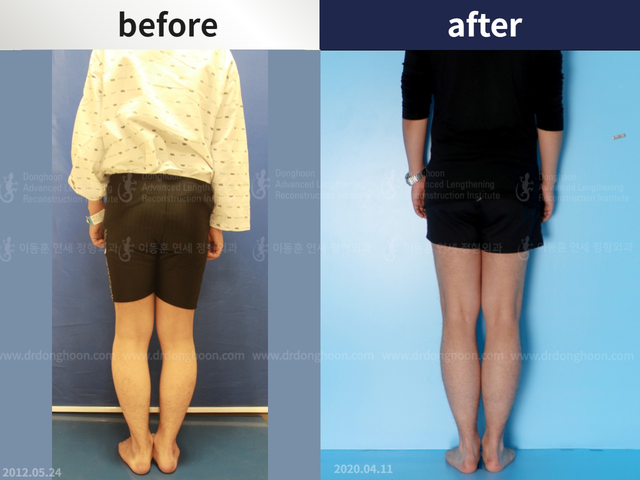 Before and after cll precice, case 4573572, image 2, Dr. Donghoon institute (DALRI)