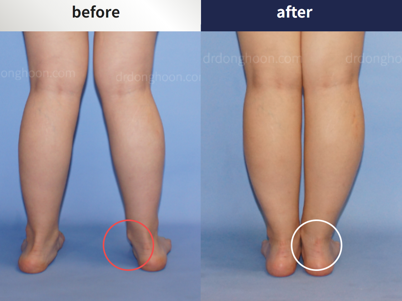 Before and after foot & ankle deformity, case 4248128, image 2, Dr. Donghoon institute (DALRI)