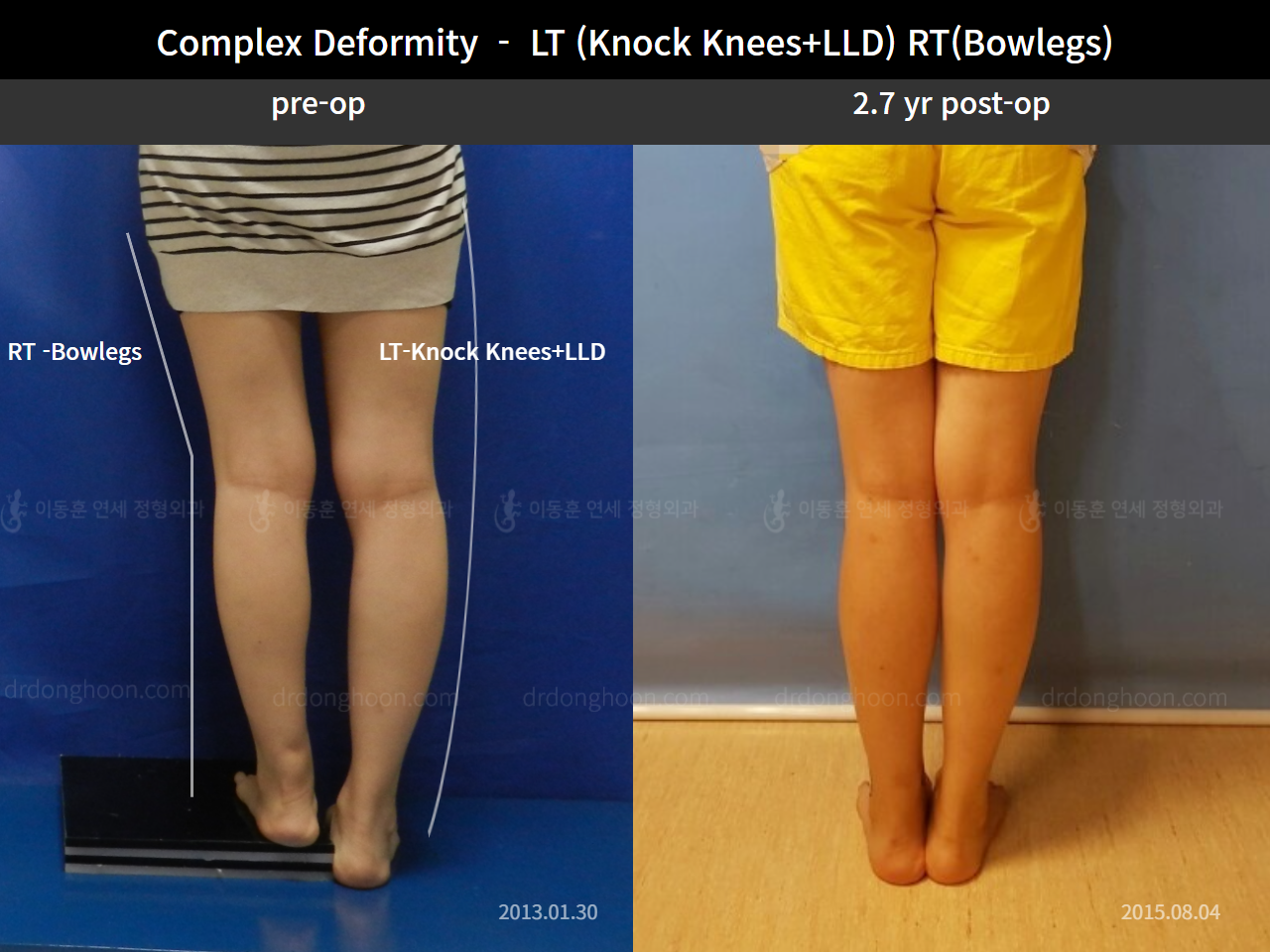 Before and after adult bowlegs, case 7382699, image 2, Dr. Donghoon institute (DALRI)