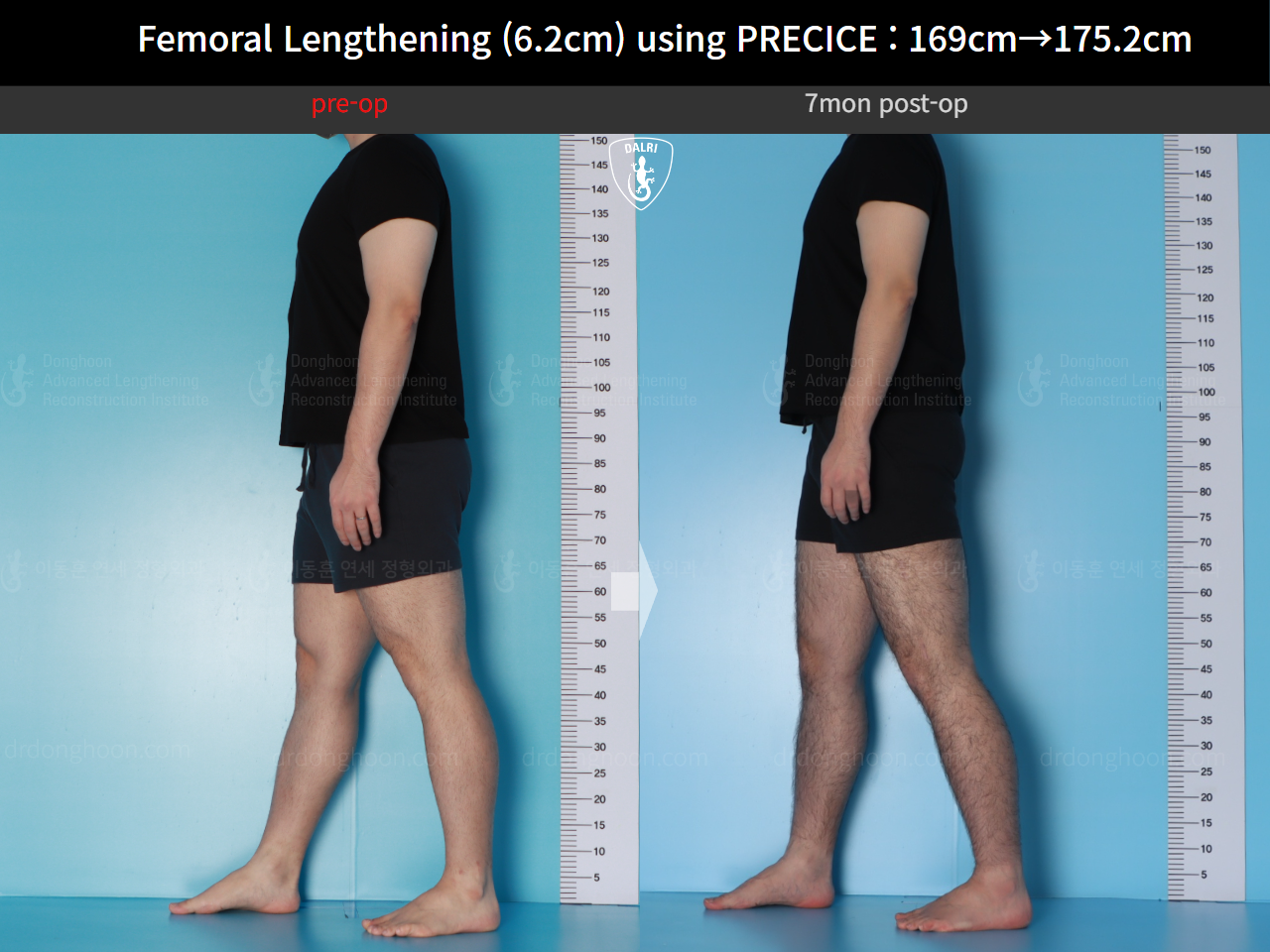 Before and after cll precice, case 20671201, image 4, Dr. Donghoon institute (DALRI)