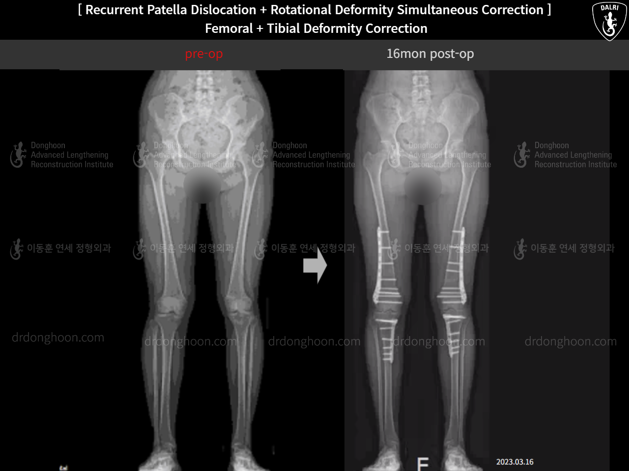 Before and after recurrent patella dislocation, case 15131180, image 6, Dr. Donghoon institute (DALRI)