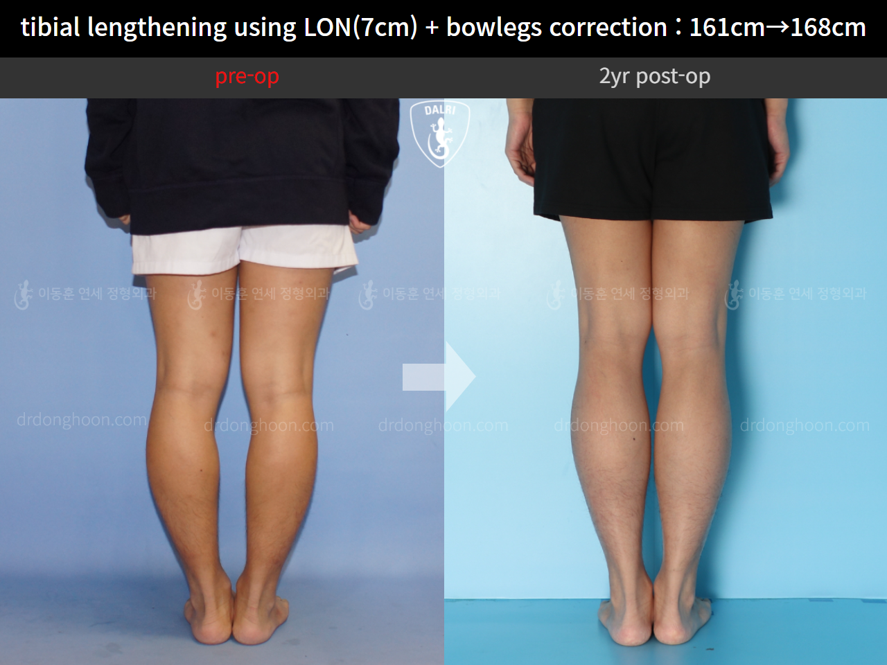 Before and after cll + deformity correction, case 10400088, image 6, Dr. Donghoon institute (DALRI)