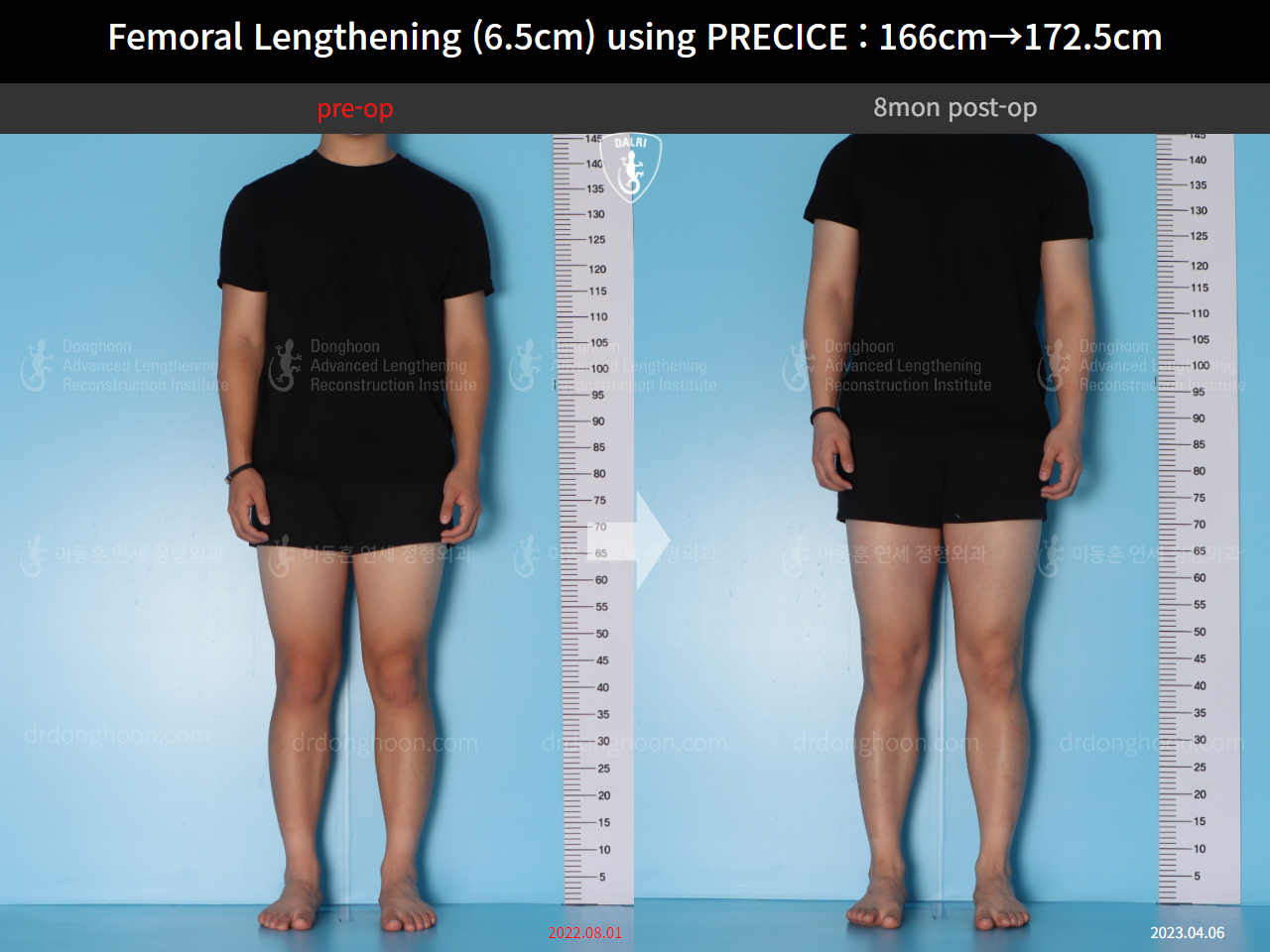 Before and after cll precice, case 14706614, image 2, Dr. Donghoon institute (DALRI)