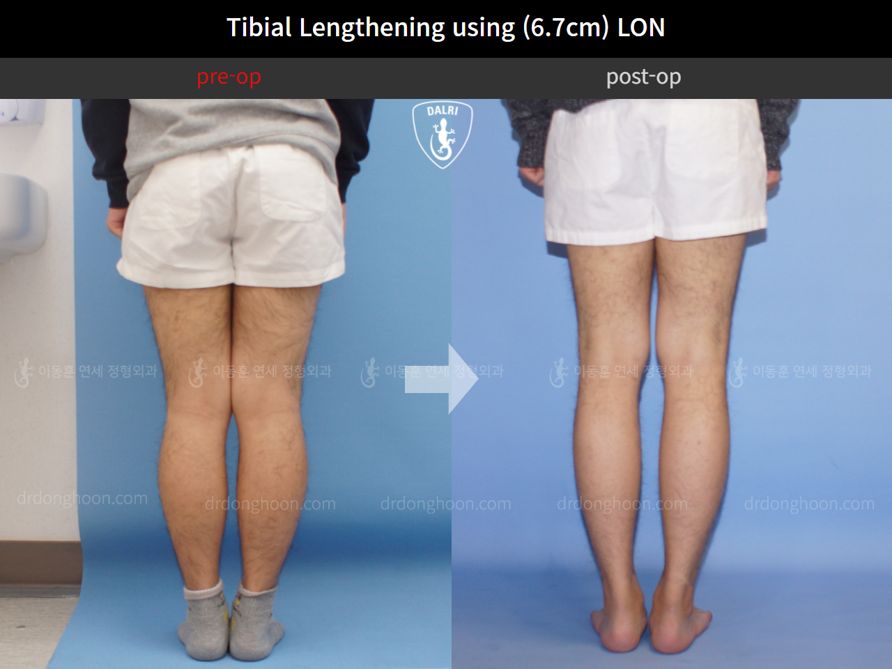 Before and after cll lon, case 4577979, image 4, Dr. Donghoon institute (DALRI)