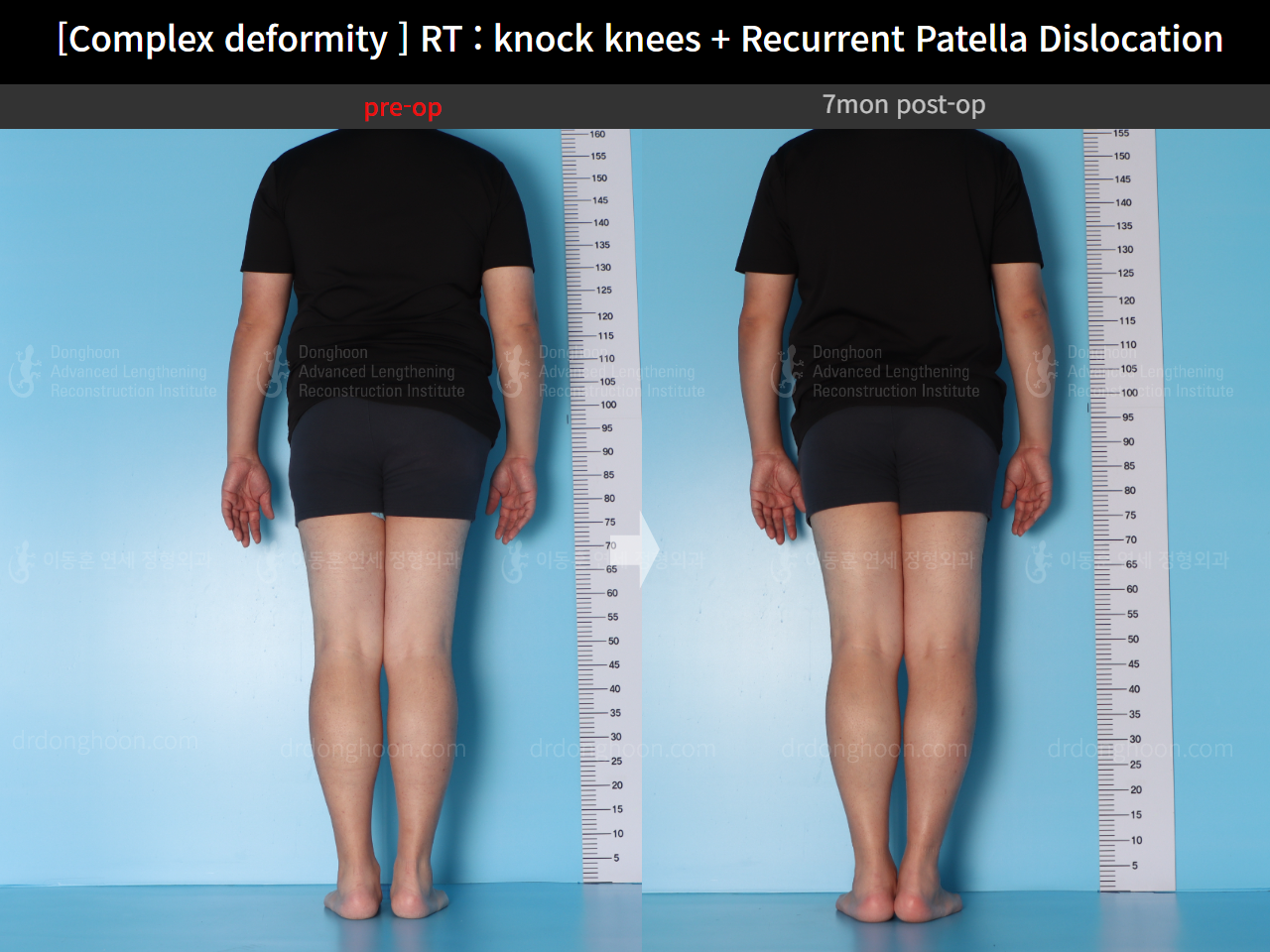 Before and after recurrent patella dislocation, case 16147031, image 4, Dr. Donghoon institute (DALRI)