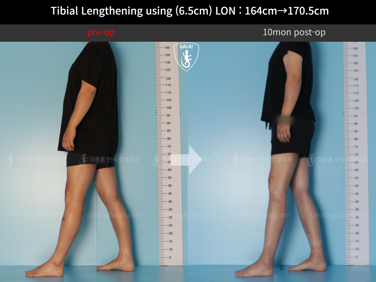 Before and after cll lon, case 11925236, image 3, Dr. Donghoon institute (DALRI)